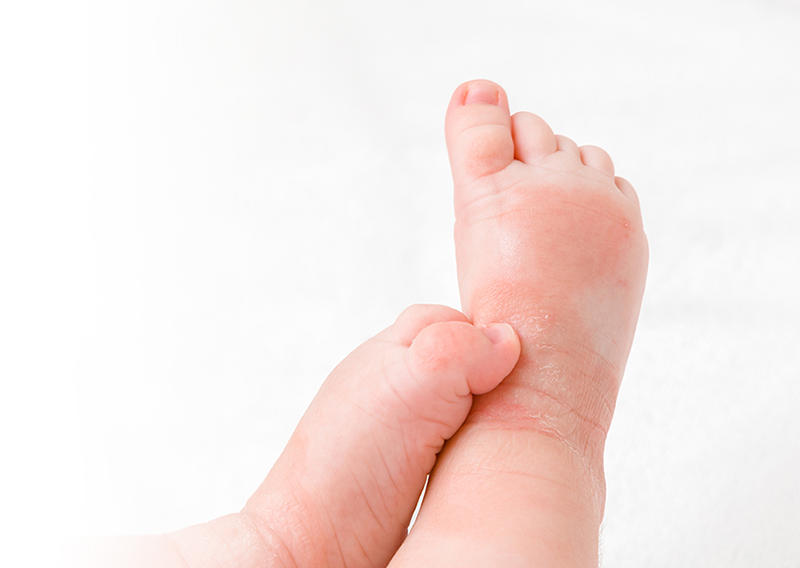 蕁麻疹